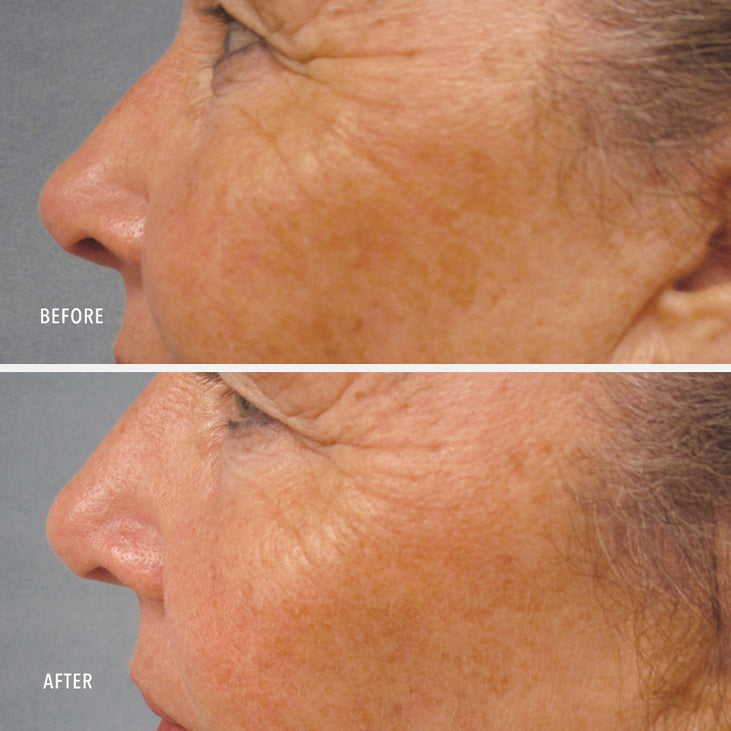 LUMAPRO-C SERUM - Skin Brightening Pigment Corrector