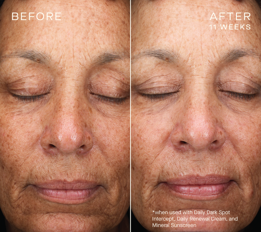 Daily Dark Spot Intercept