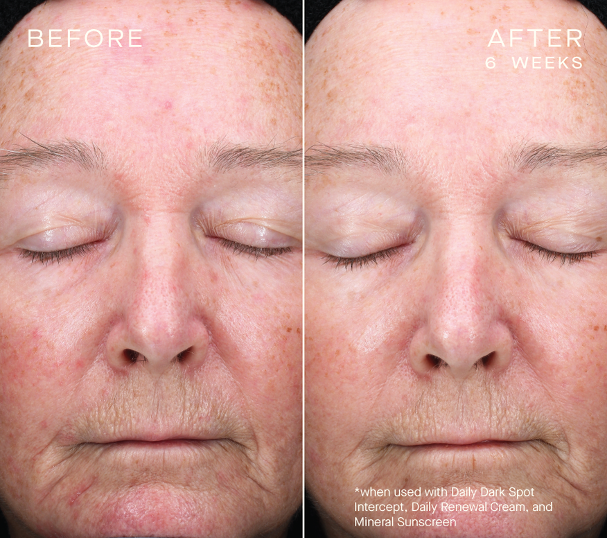 Daily Dark Spot Intercept