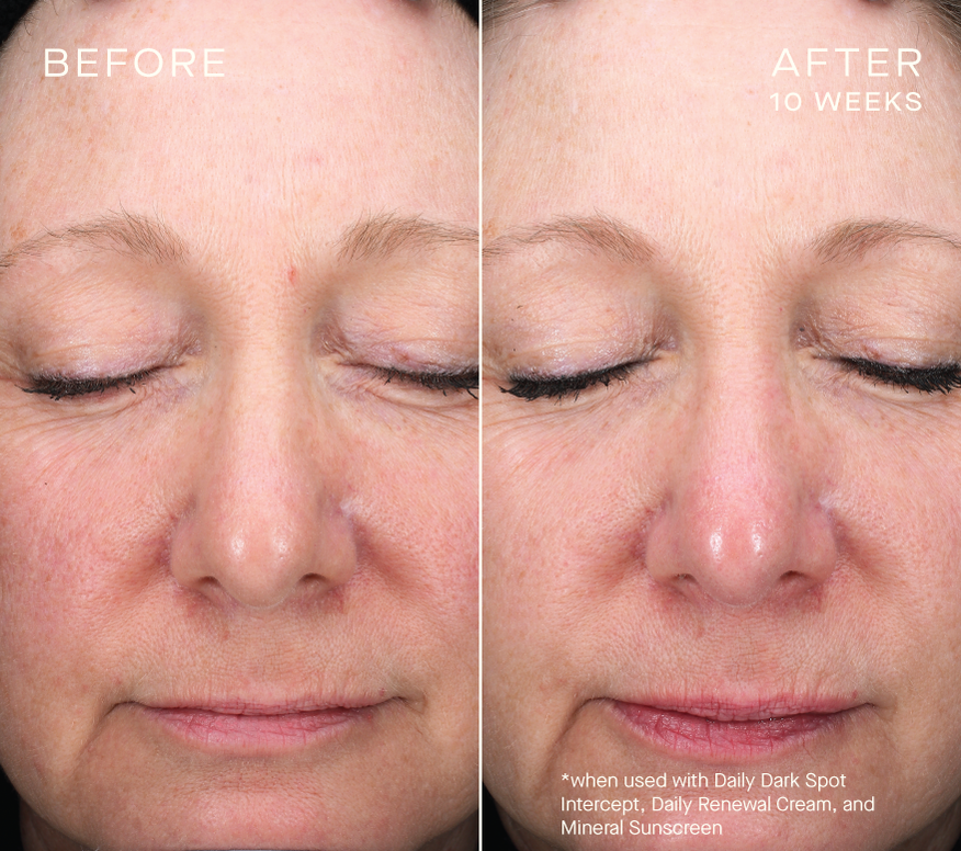 Daily Dark Spot Intercept