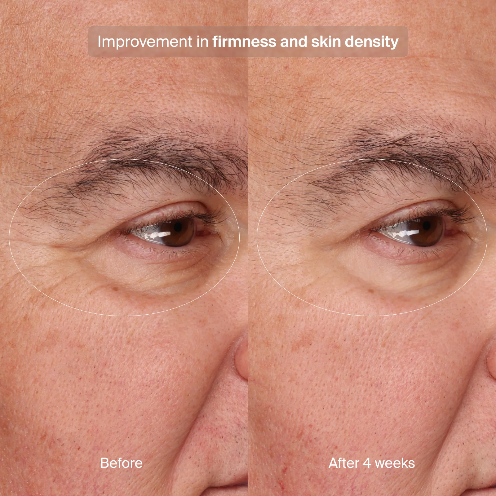 PRECISION EYE LIFT