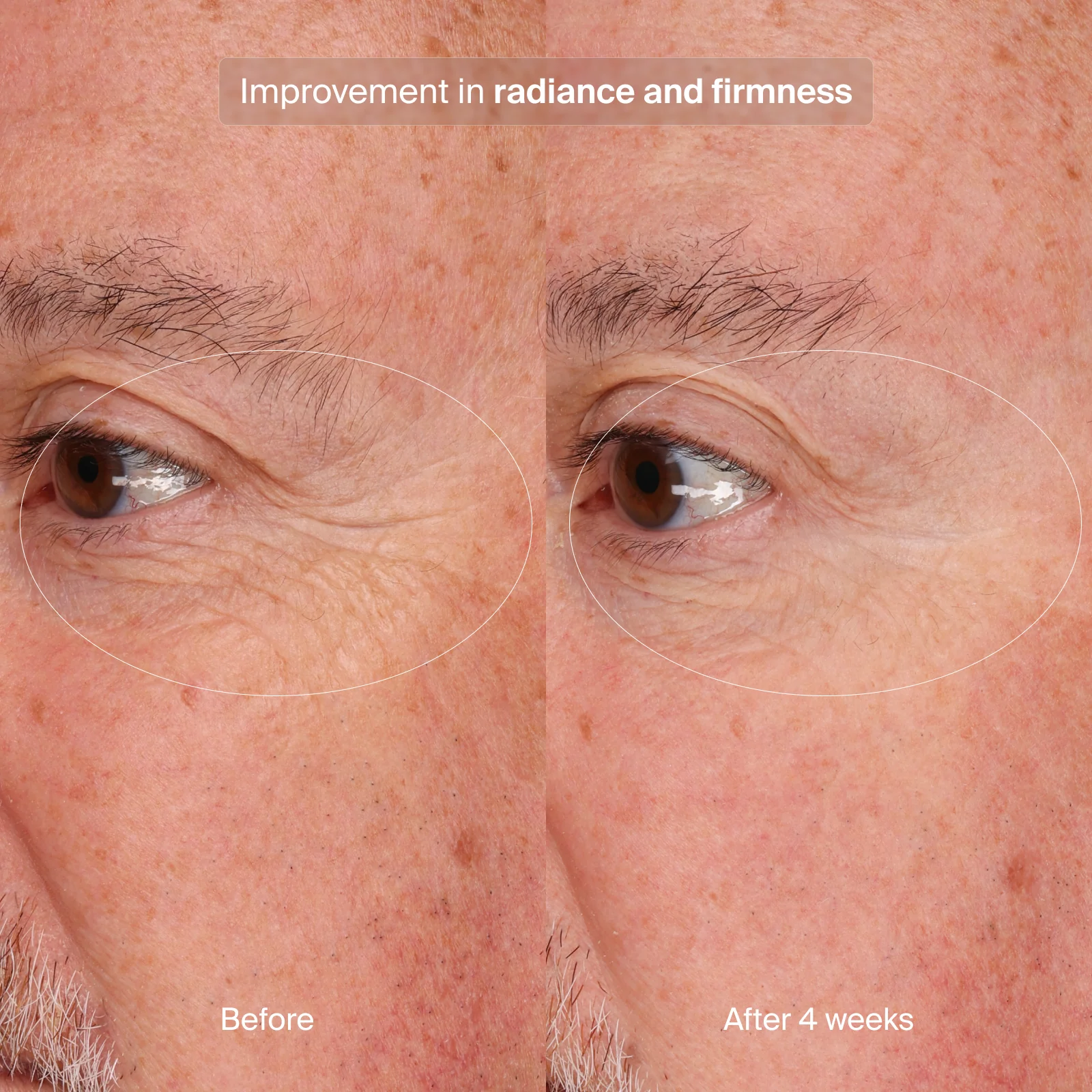 PRECISION EYE LIFT