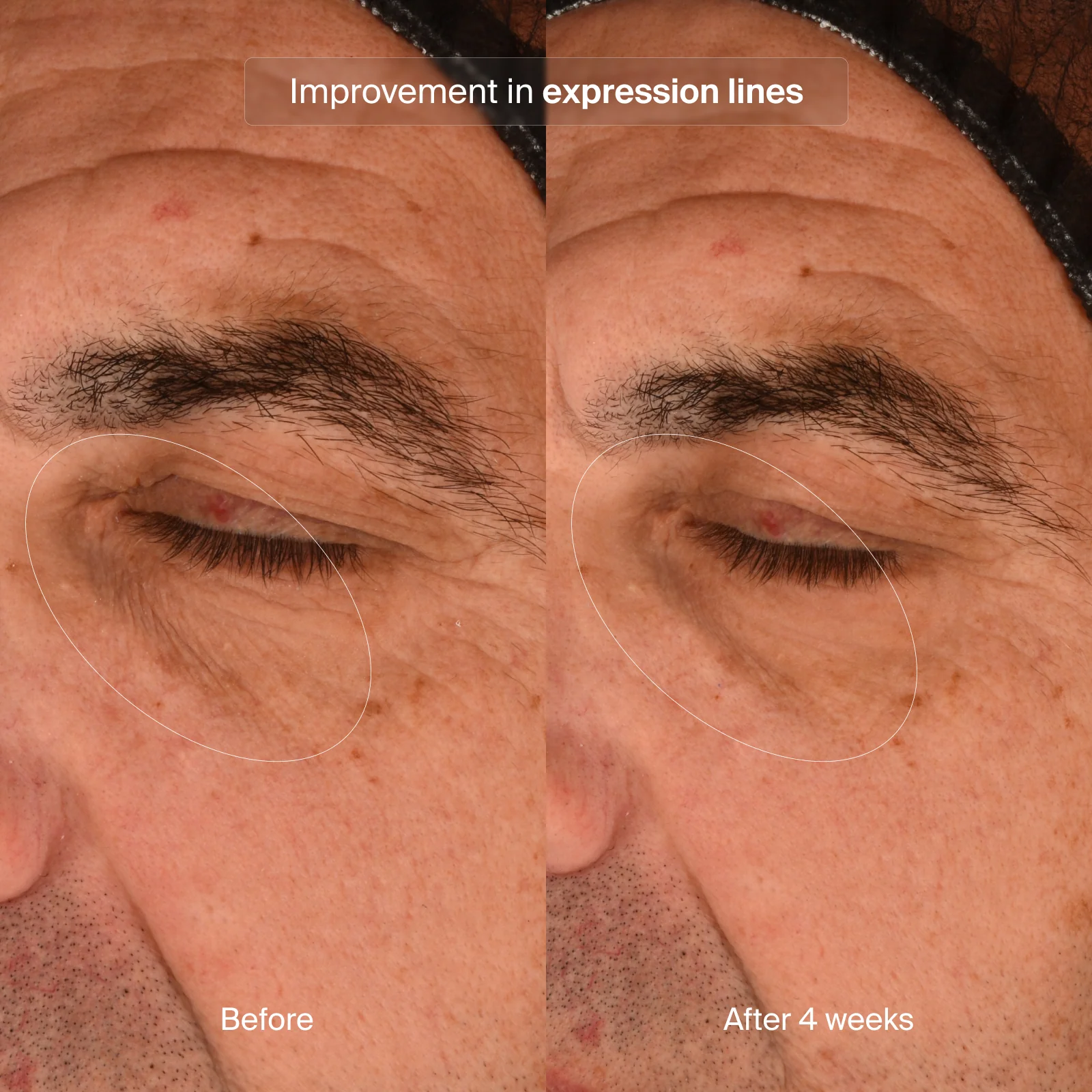 PRECISION EYE LIFT