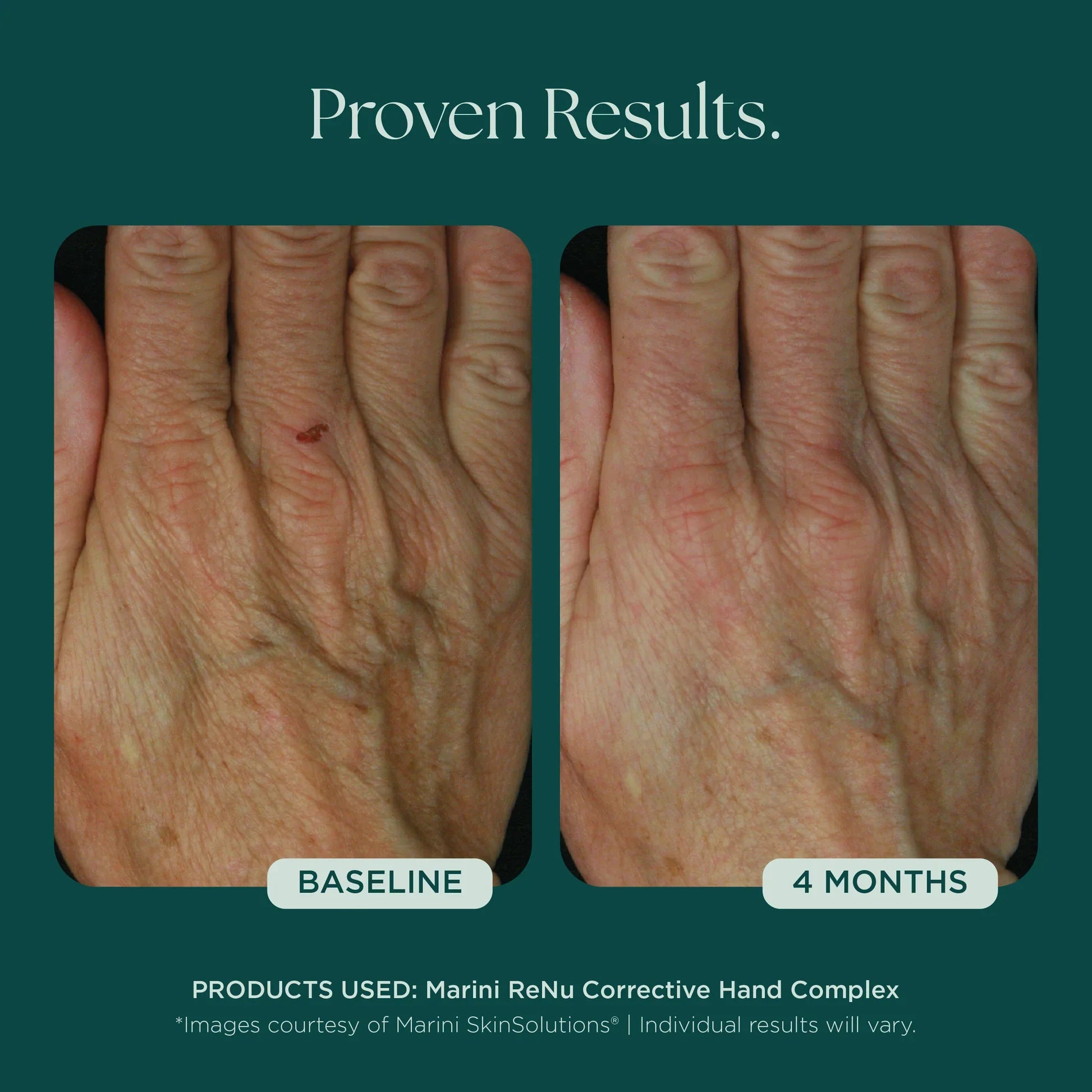Marini ReNu Corrective Hand Complex