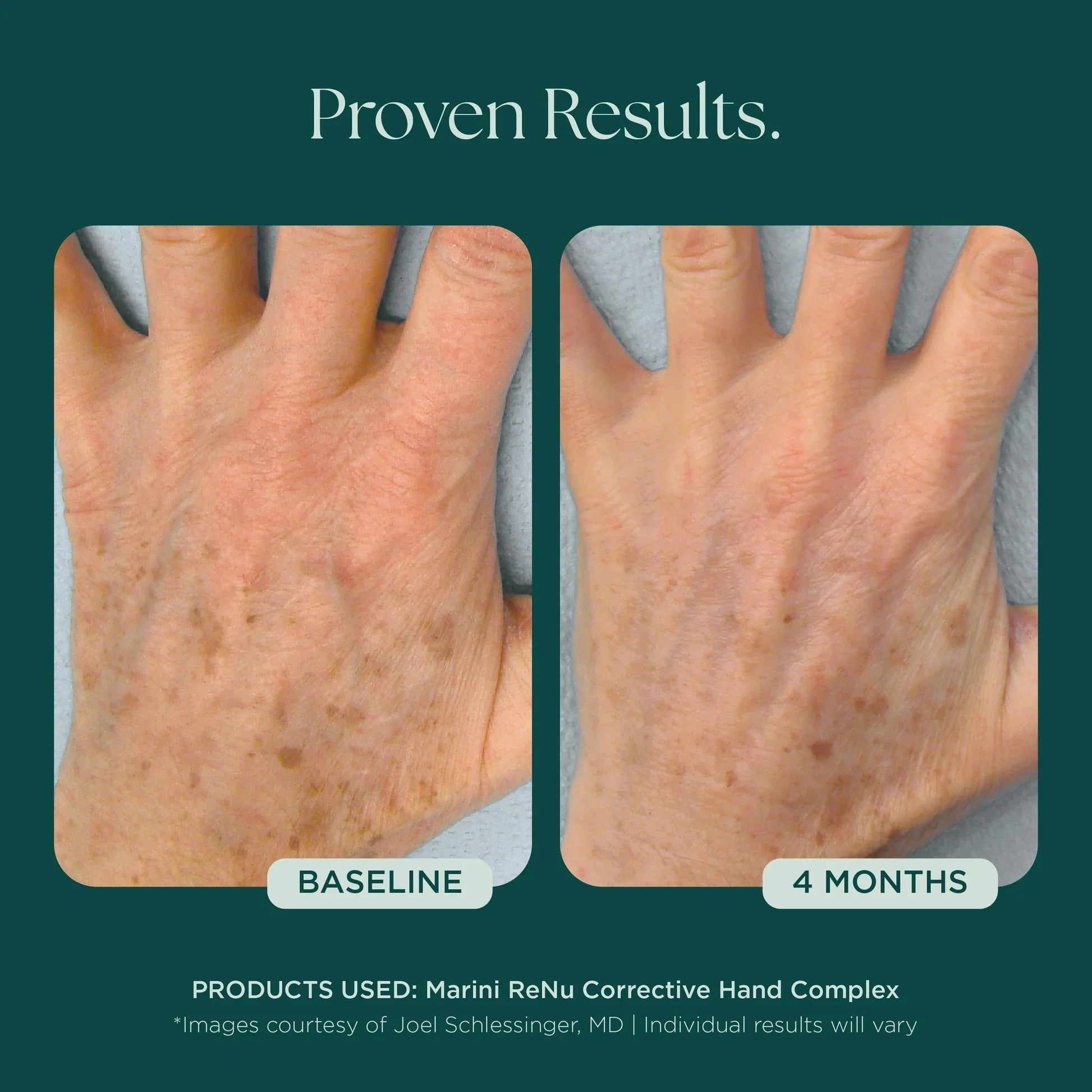 Marini ReNu Corrective Hand Complex