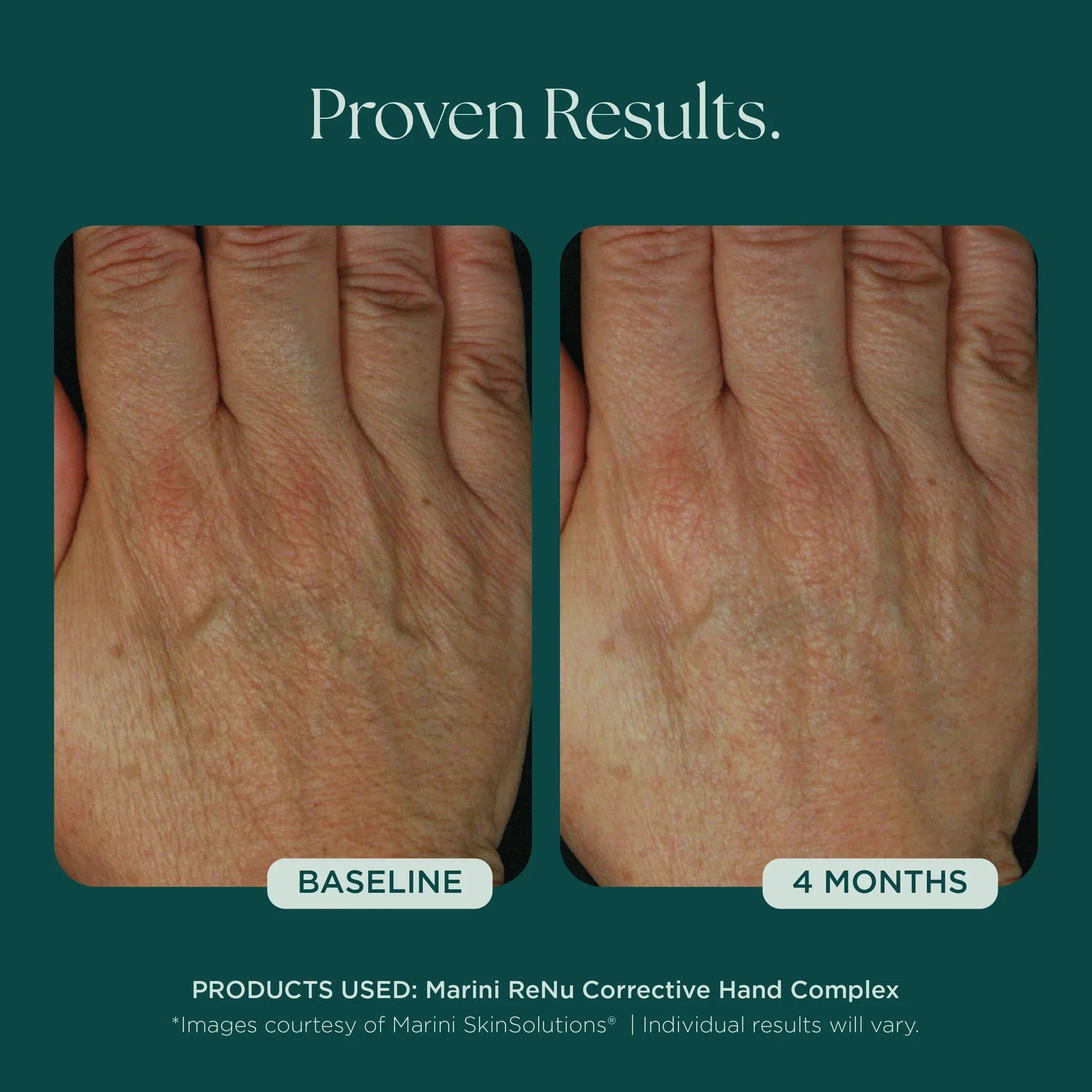 Marini ReNu Corrective Hand Complex