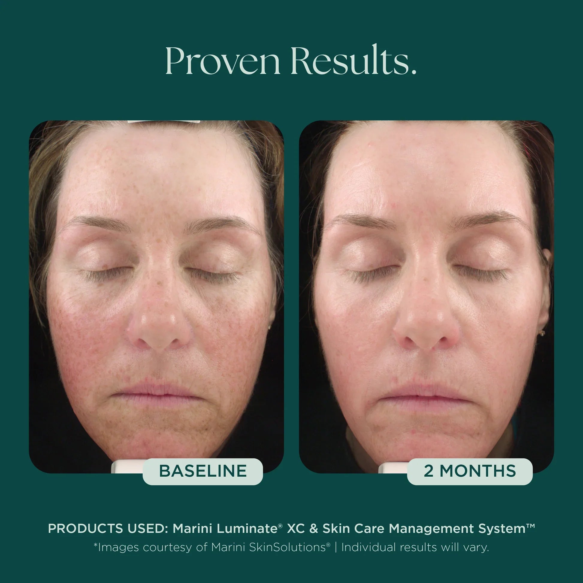 Marini Luminate® XC