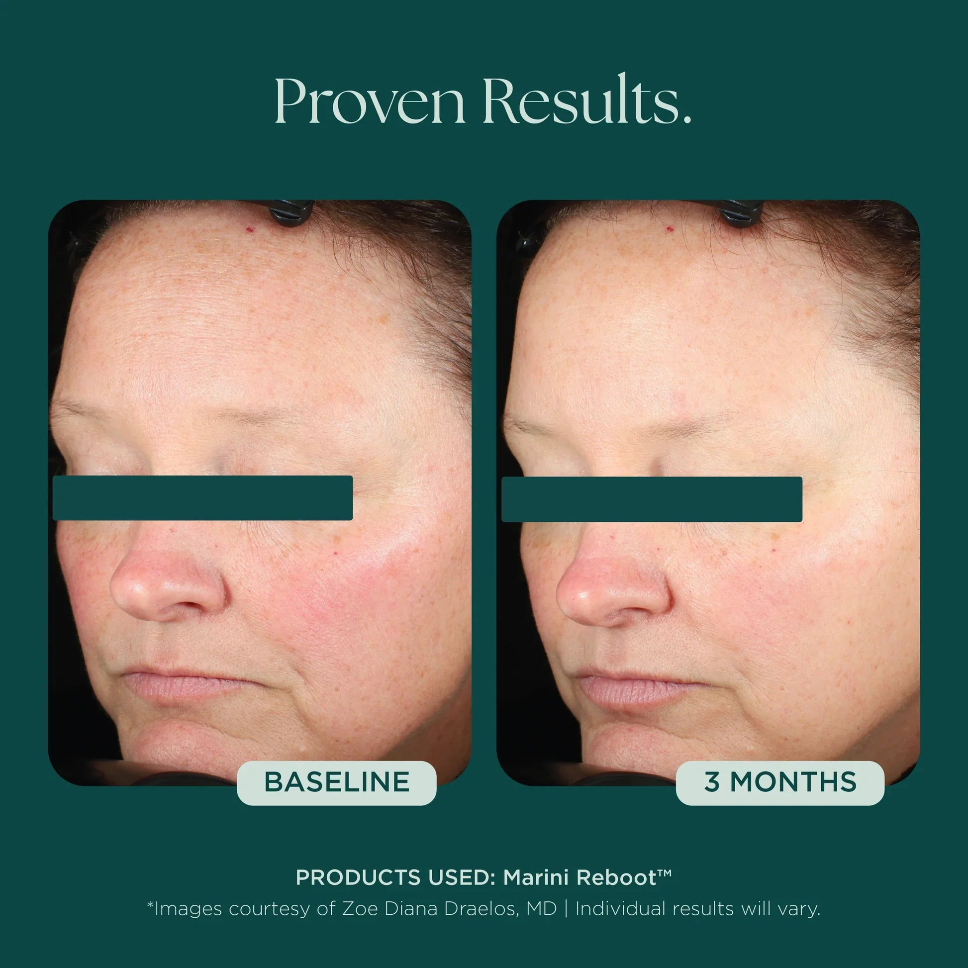 Marini Reboot® PDRN Face Serum