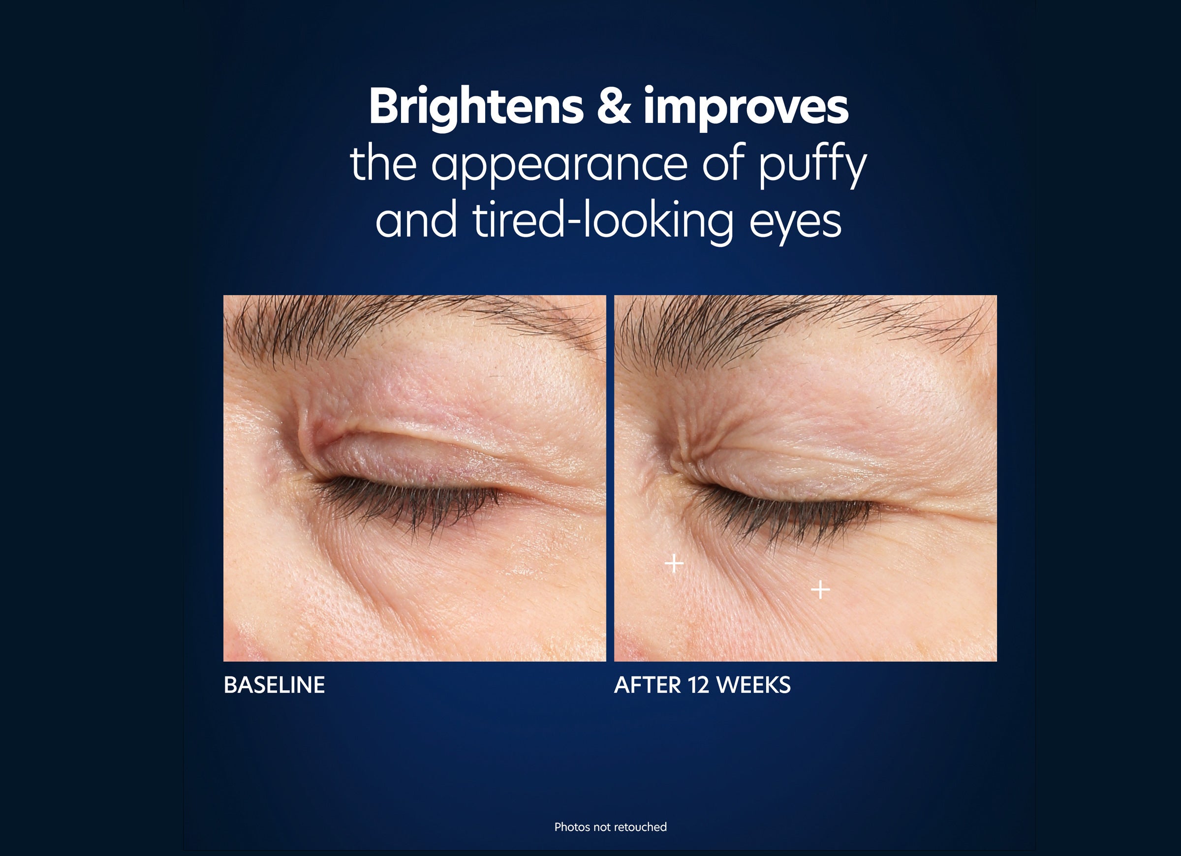 Hyaluronic Acid Microneedle Eye Patches - 1 Treatment